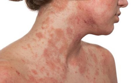 Una mujer con la piel infectada en el escote y en la parte inferior del rostro.