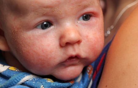 El rostro de un bebé con la piel descascarada y enrojecida.