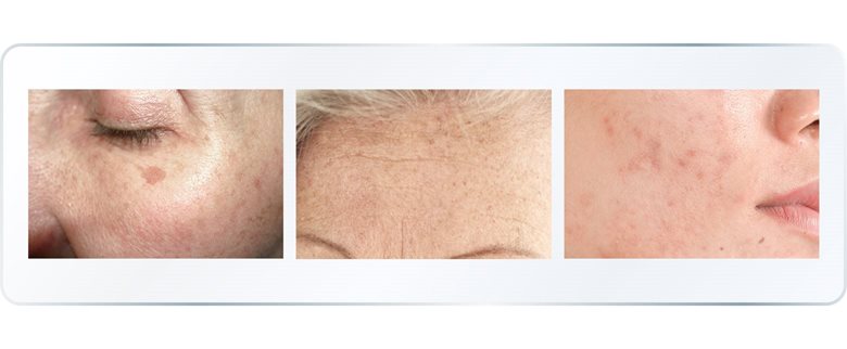 Uneven skin tone on face and hands
