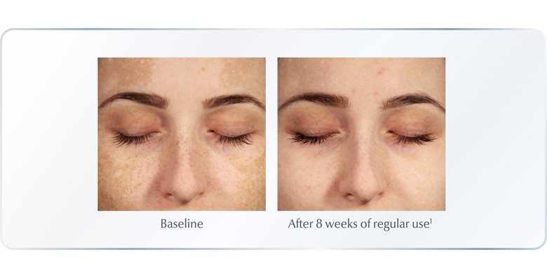 Eucerin Anti-Pigment reduces hyperpigmentation